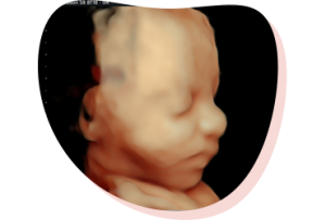 3d-4d-echo-pretcho 3D 4D pretecho